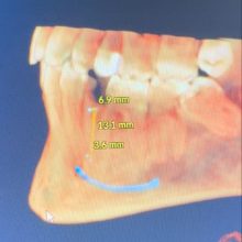 Oral surgery, nerve localisation and immediate implant