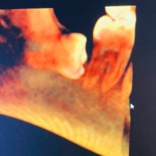 Complex wisdom tooth surgery with CBCT / 3D planning