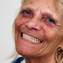 Implant-supported denture (klikgebit)